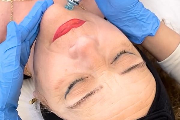 hydrafacial-eb Hydrafacial limpieza facial profunda. Paciente en Clínica de Medicina Estética EB