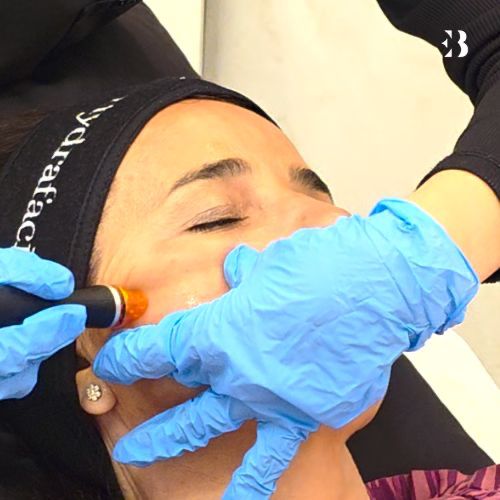 Peeling hydrafacial. Paciente Carmen Alcayde EB