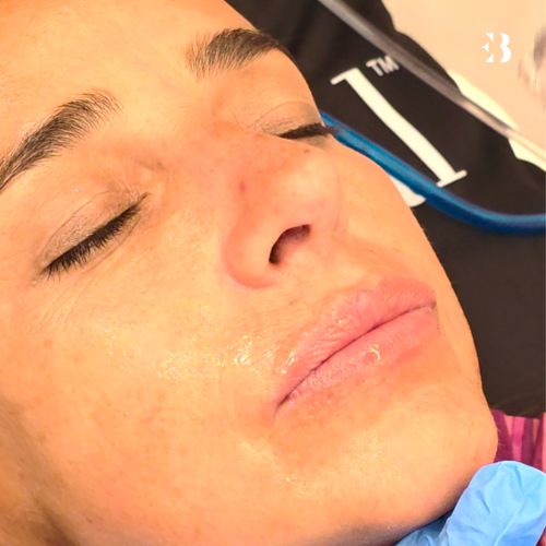 Serum hidratación hydrafacial. Paciente Carmen Alcayde EB