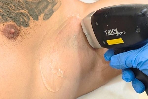 depilación laser en el Centro de Depilación Láser EB