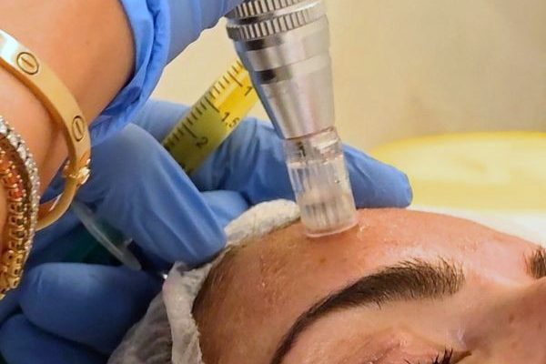 Dermapen con exosomas. Paciente de Clínica EB Dermapen con exosomas. Paciente de Clínica EB