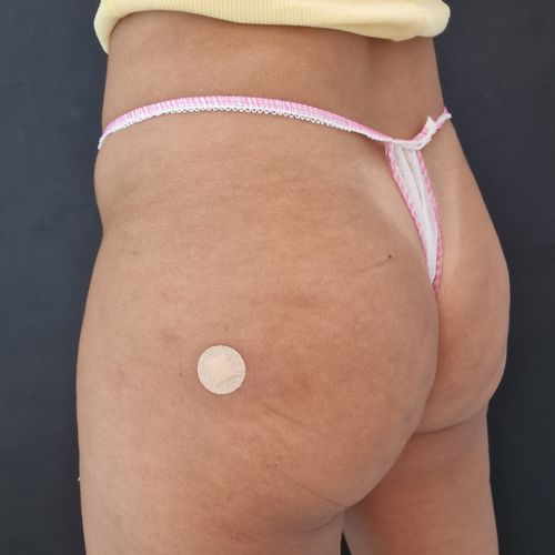 aumento de glúteos despues en la clinica de medicina estética EB en Madrid