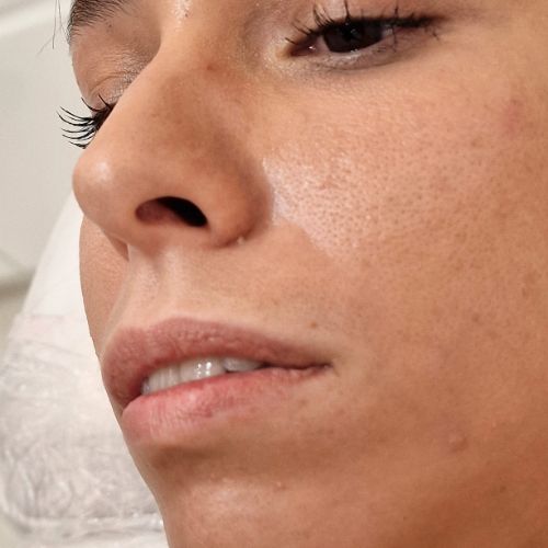 El Antes de tratamiento aumento de labios con ácido hialurónico en la clínica de medicina estética EB en Madrid