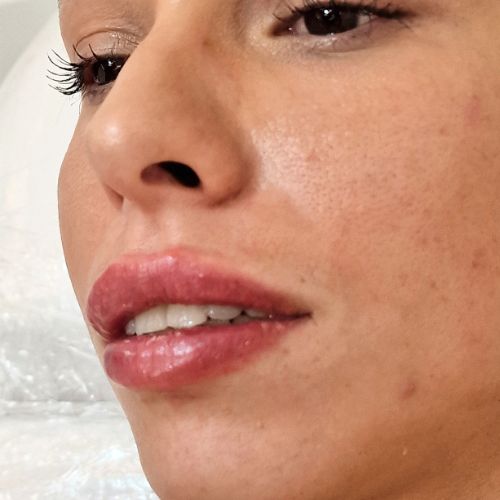 El Después de tratamiento aumento de labios con ácido hialurónico en la clínica de medicina estética EB en Madrid