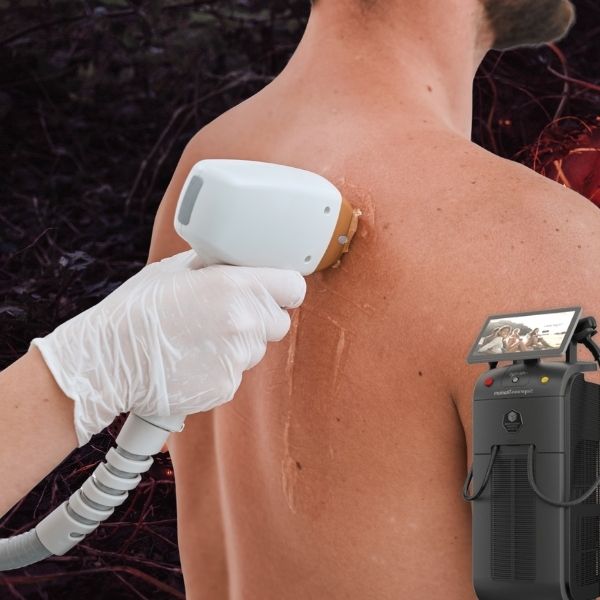 depilación laser chico cuerpo entero