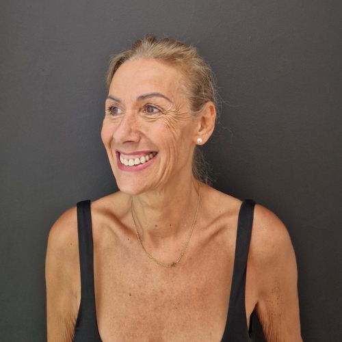 Tratamiento Full Face Antes en la Clínica de Medicina Estética de Madrid EB