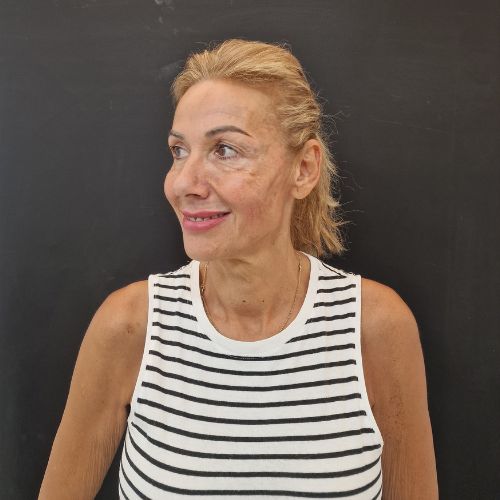 Tratamiento Full Face Después en la Clínica de Medicina Estética de Madrid EB
