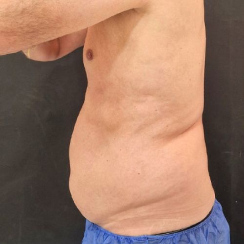 El Antes de tratamiento eliminar grasa localizada con Coolsculpting en la clínica de medicina estetica EB en Madrid