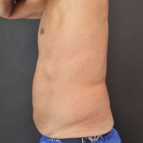 El Después del tratamiento eliminar grasa localizada con Coolsculpting en la clínica de medicina estética EB en Madrid