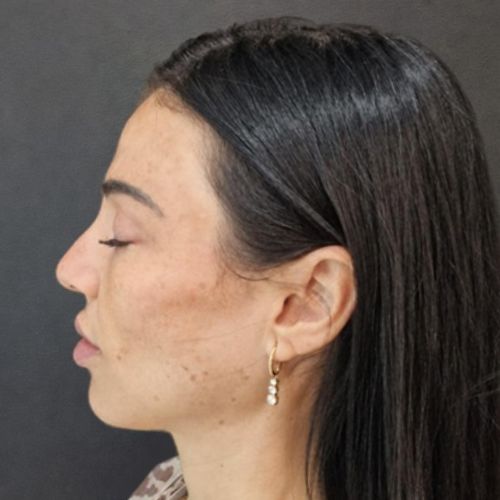 El antes del tratamiento de Rinomodelación en la clínica de medicina estética EB
