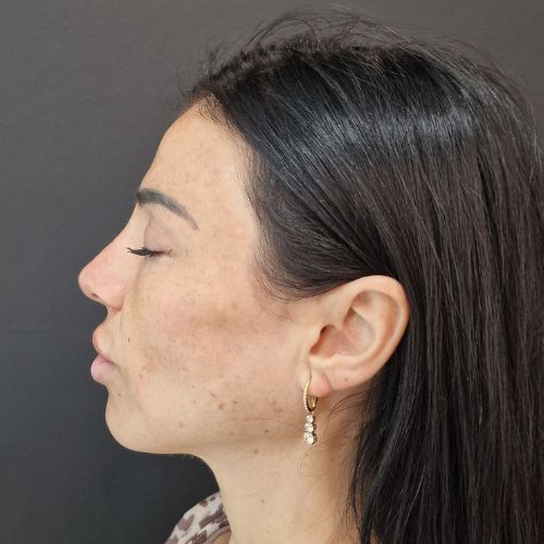 El después de la tratamiento de Rinomodelación en la clínica de medicina estética EB